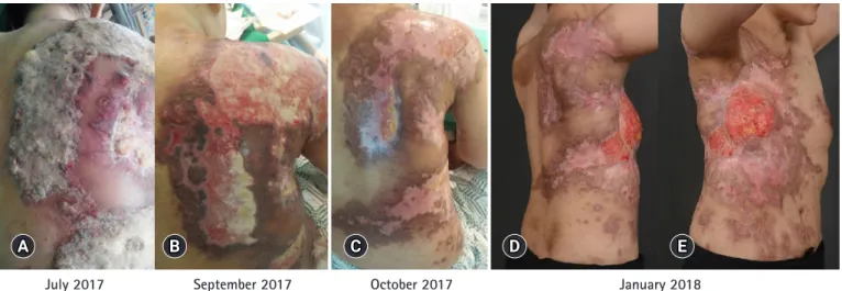 Fig. 3. Before the cisplatin treatment, the patient complained of widespread skin metastases with discharge and generalized edema  (A)
