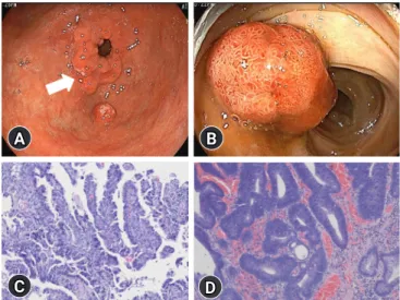 Fig. 1.  Initial abdominal computed tomography shows a low  attenuated lesion (arrow) measuring approximately 2.1×1.8 cm in  size with an irregular margin in the right liver lobe in the portal  phase.