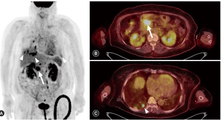 Fig. 4. 18 F-2-fluoro-2-deoxy-D-glucose-positron emission tomography integrated with computed tomography