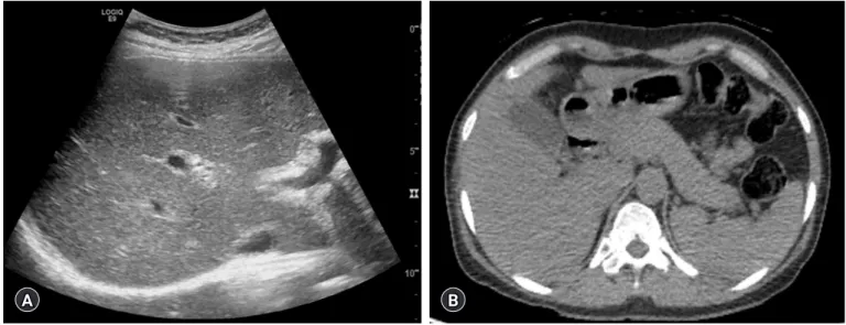 Fig. 1. Abdominal sonography and computed tomography showing (A) increased echogenicity of the liver parenchyma with heterogeneous  echotexture and (B) normal pancreas without significant evidence of autoimmune pancreatitis.