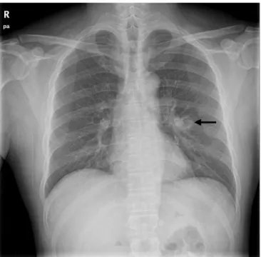 Fig. 2.  Chest computed tomography reveals a smooth internal  margin of a cavitary mass (approximate size, 2.4 cm) with  surrounding reticulonodular opacities (arrow) in the superior  segment of the left lower lobe.