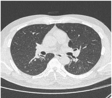 Fig. 4.  Chest computed tomography after 2 months reveals  complete resolution of the cavitary lesion in the superior segment  of the left lower lobe.