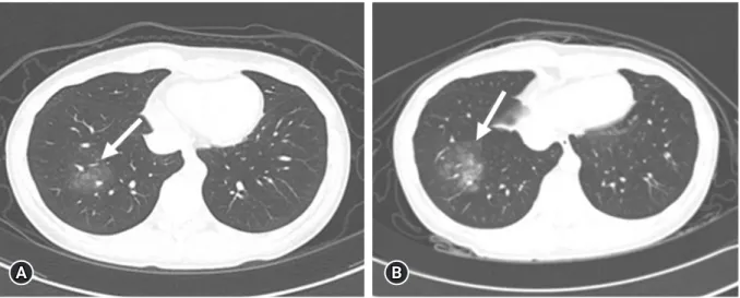 Fig. 1.  Chest CT scan performed during menstruation. (A) A GGO lesion (arrow) is visible in the right lower lung field on chest CT  performed 5 months prior