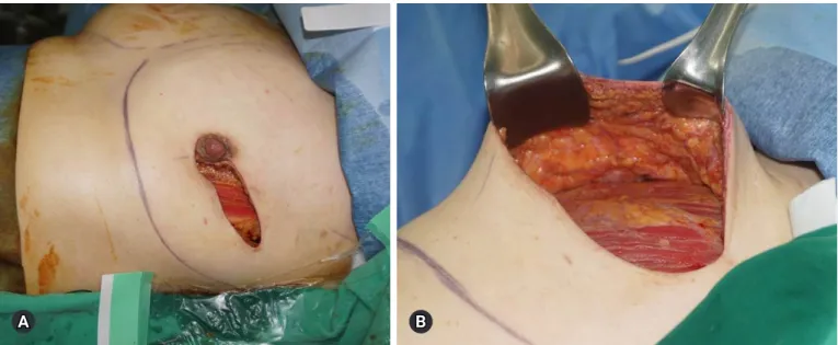 Fig. 1. The mastectomy skin flap has good vascularity (A), and a moderate amount of fat tissue is preserved (B).