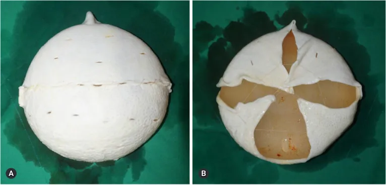 Fig. 2.  Two sheets of fenestrated acellular dermal matrices are sewn together and draped over the implant (A)
