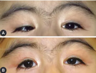 Fig. 2. Preoperative image of the patient demonstrating esotropia  and ptosis covering the visual axis of the right eye (A)