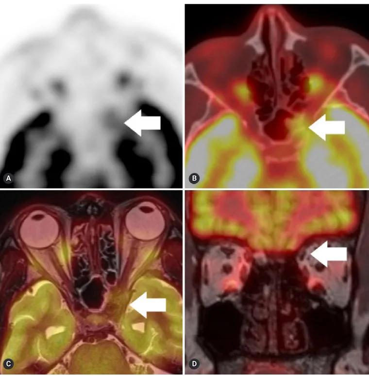 Fig. 2.  Transaxial PET, PET/CT, PET/MRI show a hypermetabolic soft tissue mass (arrows, SUVmax 3.7) extending to the optic canal and superior  orbital fissure (A-C)