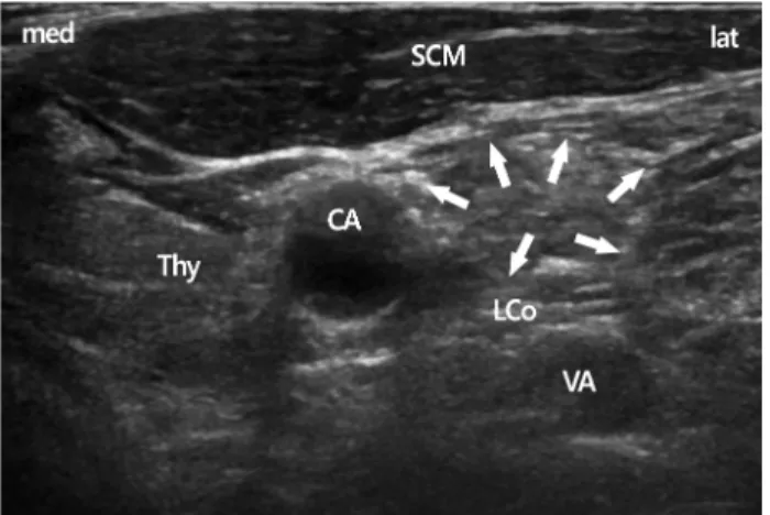 Fig. 2. In the C7 transverse view, the vertebral artery come out  from the tubercle and is seen easily