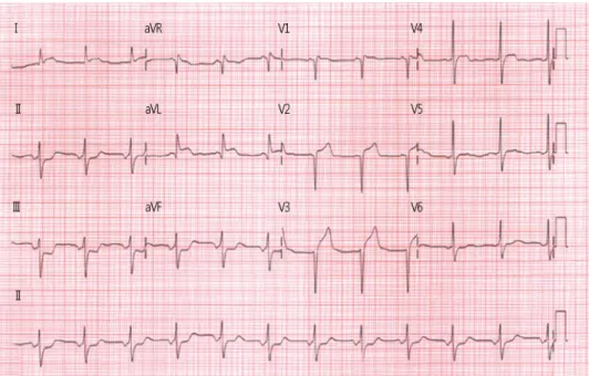 Fig. 1. Initial electrocardiogram findings. There is normal sinus rhythm with ST elevation in leads I, aVL and V1-3, and ST segment depression in leads II, III and aVF.
