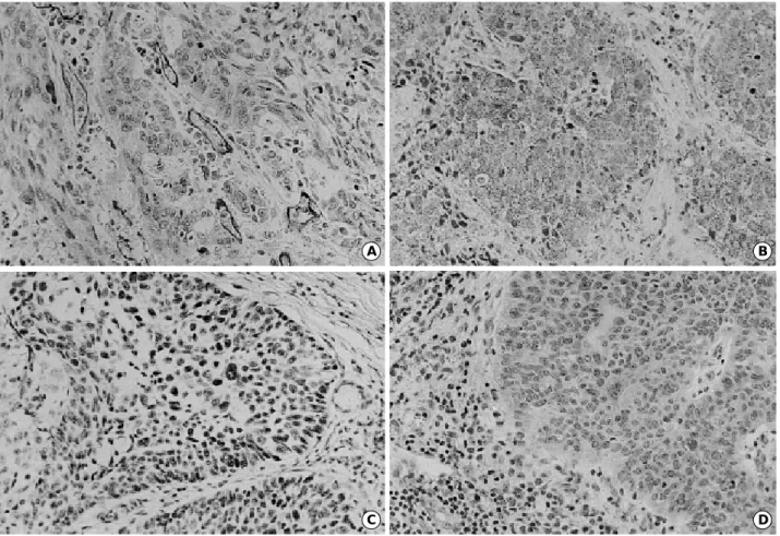 Fig. 1. A: Tumor area with high microvessel count in squamous cell carcinoma (ABC method, ×200)