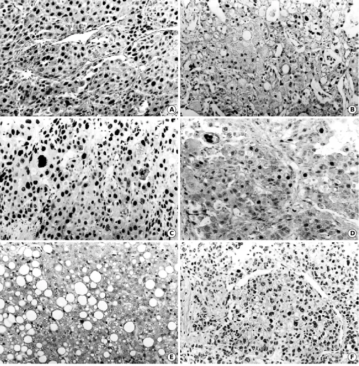 Fig. 1. Representative examples of immunohistochemical staining of the G1-S modulators in HCCs (A-D, F, G, I) and dysplastic nodules (E, H, J)