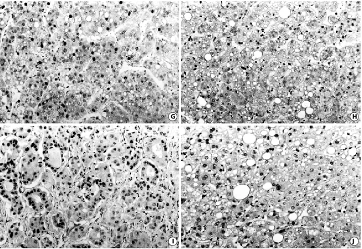 Fig. 1. (Continued from the previous page) Nuclear immunoreactivity for p16 in HCC Ed II (G) and high grade dysplastic nodule (H)