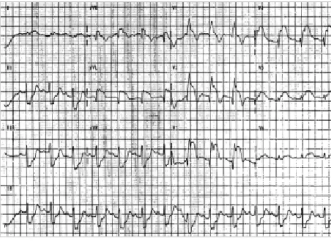 Fig. 1. Twelve-lead electrocardiogram demonstrates complete right bundle branch block, PR prolongation with left axis  devia-tion, and ST-segment elevation over the precordial and lateral leads through V1 to V6, I and aVL.
