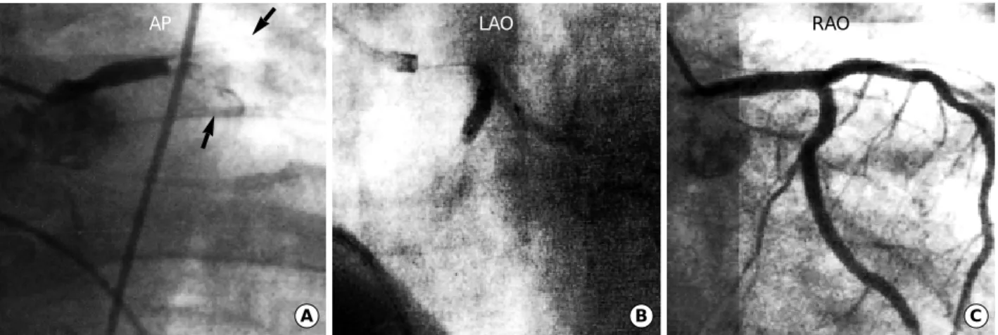 Fig. 2. (A) Emergent coronary angiogram obtained immediately after placing temporary pacing electrode reveals total thrombotic occlusion in the left main stem