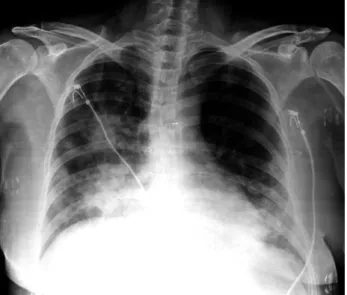 Fig. 1. The initial chest X-ray showed pneumonic consolidations in both lung fields.
