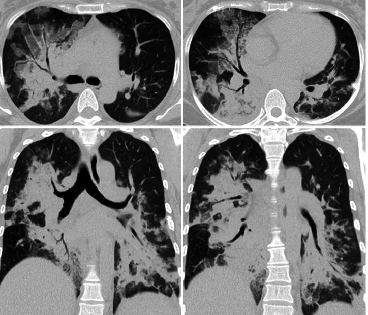 Fig. 2. Chest computed tomography scan showed diffuse patchy consolidations with air bronchograms and mild interlobular septal thickening in both lungs.