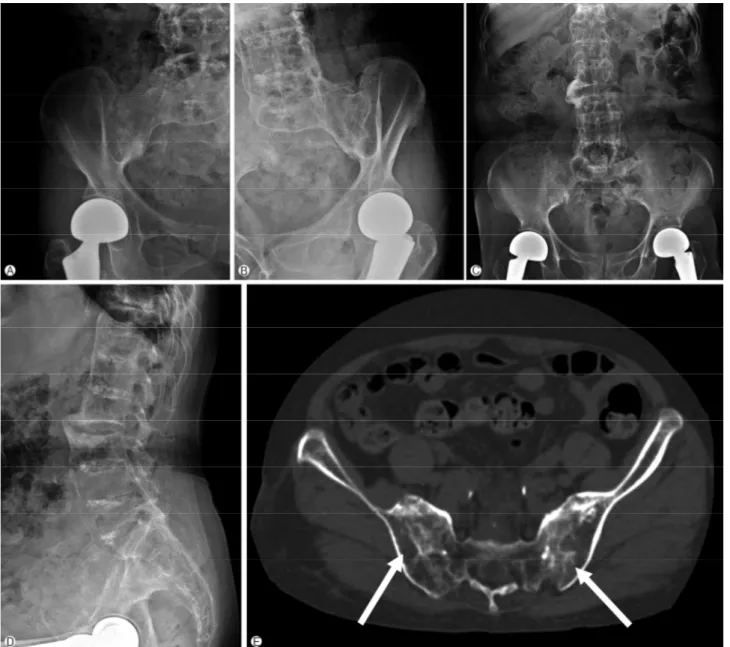 Fig. 1. Simple X-ray of sacroiliac joint, right (A), left (B), anteroposterior (C), and lateral radiographs (D) of the lumbosacral spine  showed bilateral sacroiliitis and syndesmophytes of lumbar spines