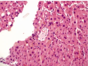Fig. 3. Histologic finding shows mild and focal chronic hepatitis and cholestasis without any features suggesting fibrosis or  cirr-hosis (H&amp;E stain, ×200).