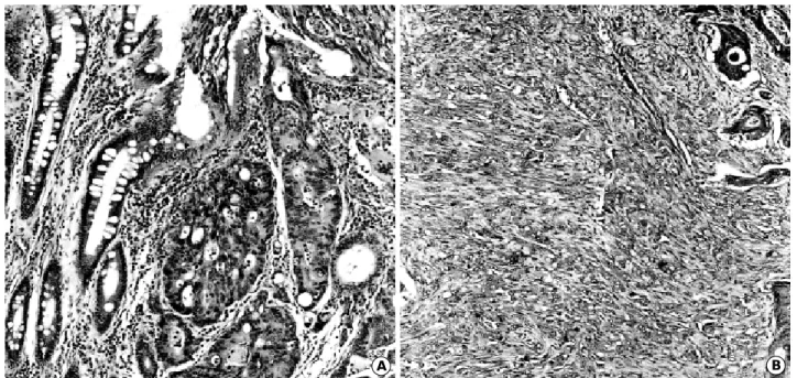 Fig. 1. Photomicrographs show moderately differentiated adenocarcinoma on superficial portion of the colon (A) and a proliferation of polygonal or spindle-shaped anaplastic tumor cells in sheet or short fascicular pattern, intermixed with differentiated ad