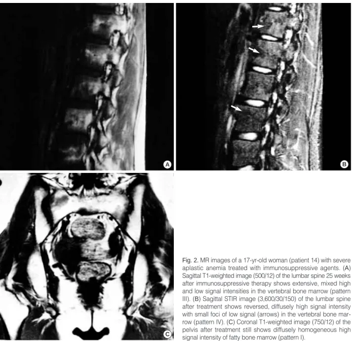 Fig. 2. MR images of a 17-yr-old woman (patient 14) with severe aplastic anemia treated with immunosuppressive agents
