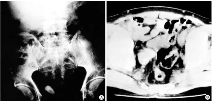 Fig. 1. Simple KUB shows a radiopaque stone in right distal ureter (A). Computed tomographic scan shows an ill-defined, low-density mass in the right distal ureter resulting in irregular thickening of the ureteral wall and obliteration of the ureteral lume