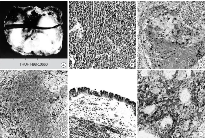 Fig. 2. On gross examination, cut surface of the right ureter shows the luminal narrowing caused by intramural infiltrative mass, which mainly involved the anterior half (A)