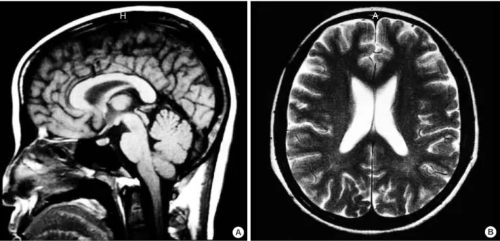 Fig. 1. Brain MRI images (T1-weighted sagittal and T2-weighted axial) show normal sized ventricle and subarachnoid space without space-occupying lesion.