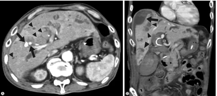 Fig. 2. Follow-up abdominal computed tomography. (A) Two intrahepatic psuedoaneurysms (arrows) with partial rupture and active bleeding at liver segment 5 is observed with intrabiliary hematoma and biliary dilatation (arrow heads)