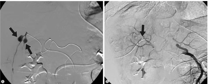Fig. 3. Initial hepatic artery angiography. (A) Two intrahepatic pseudoaneurysms (arrows) at liver segment 5 are seen