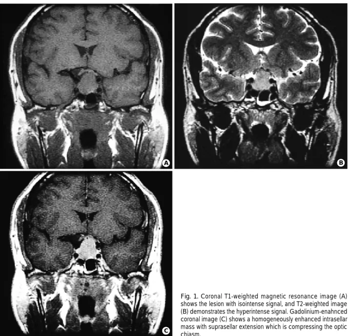 Fig. 1. Coronal T1-weighted magnetic resonance image (A) shows the lesion with isointense signal, and T2-weighted image (B) demonstrates the hyperintense signal