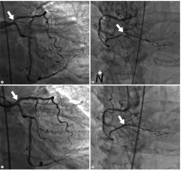 Fig. 1. Coronary angiography. (A) Initial left coronary angiography showing the significant stenosis of proximal LAD artery ostial lesion (white arrow)