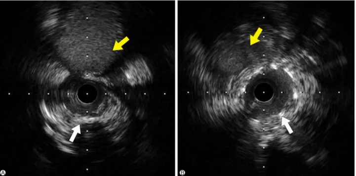 Fig. 2. Intravascular ultrasound. (A) Pre-intervention IVUS showing the eccentric echodense plaque with severe luminal narrowing at proximal LAD (white arrow), and there was not seen severe stenosis or plaque rupture at proximal LCx coronary artery (yellow