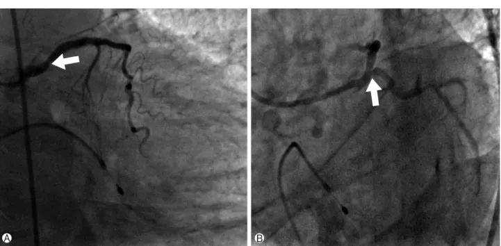 Fig. 3. Right coronary angiography and IVUS after spasm development. (A) Total  occlusion of proximal RCA due to severe spasm (white arrow)