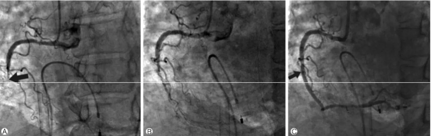 Fig. 5. Right coronary angiography after PCPS. (A) Total occlusion of mid RCA due to severe spasm (black arrow)