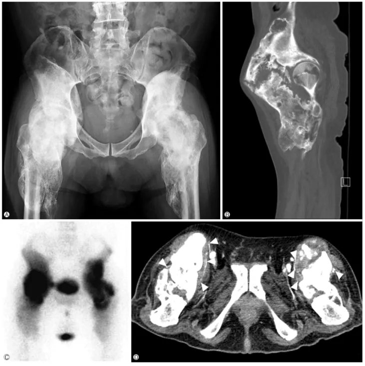 Fig. 1. (A) Pelvis anteroposterior radiograph shows diffuse heterotopic ossification around both hip joints