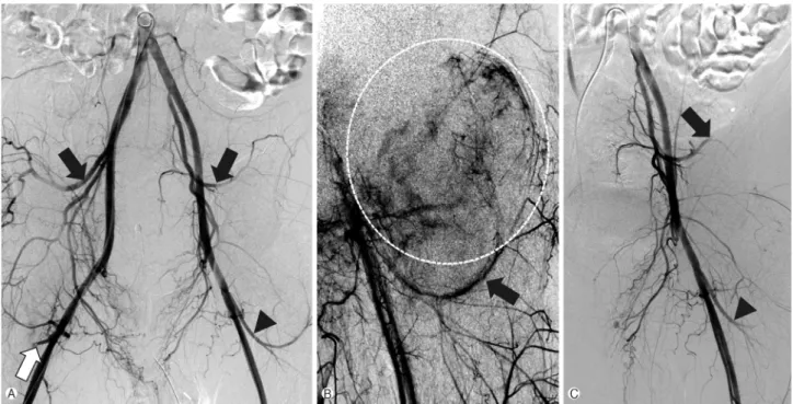Fig. 3.  (A) Gross specimen showing multiple bone fragments with hemorrhage. (B) Passive flexion of the left hip joint was available after surgical removal of heterotopic ossification