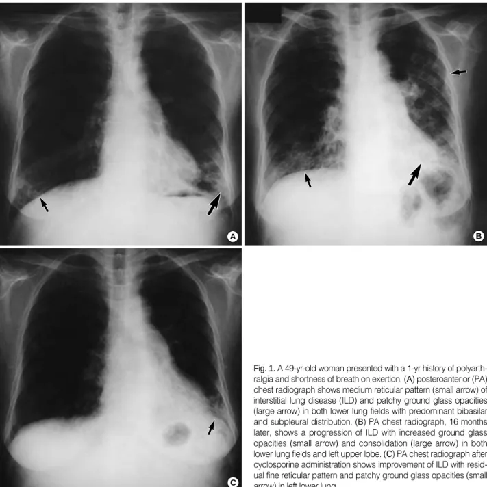 Fig. 1. A 49-yr-old woman presented with a 1-yr history of polyarth- polyarth-ralgia and shortness of breath on exertion