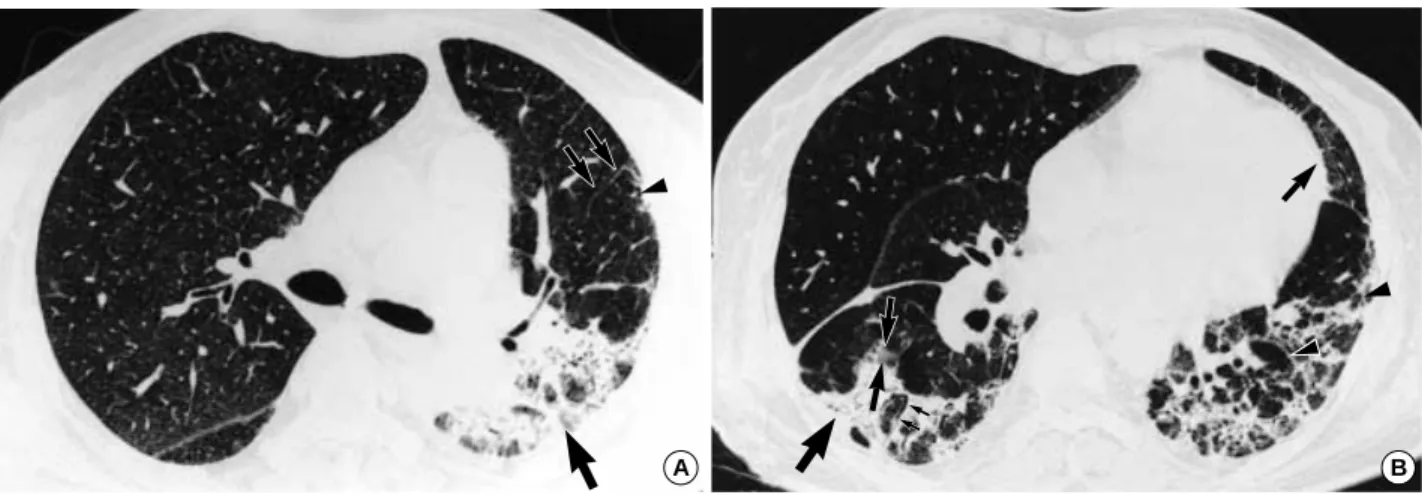 Fig. 2. (A) HRCT at the level of the carina shows consolidation (large arrow) in the posterior segment of left upper lobe and superior seg- seg-ment of left lower lobe