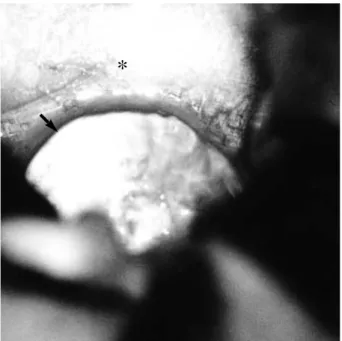 Fig. 3. Intraoperative photograph showing a translucent cystic wall (arrow), which contains clear fluid after dissection of lamina terminalis with a distended optic chiasm (asterisk).
