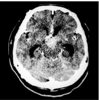 Fig. 5. Postcontrast CT scan obtained 30 months after total re- re-moval of the cystic mature teratoma via  subfrontal-interhemispher-ic translaminal approach showing homogeneously enhanced, ill-defined round shaped mass on the suprasellar region.