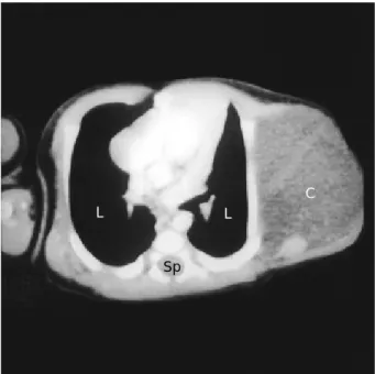 Fig. 3. Chest CT demonstrating a 8×6 cm-sized, well demar- demar-cated nonenhancing cystic mass (C) in the left lateral chest