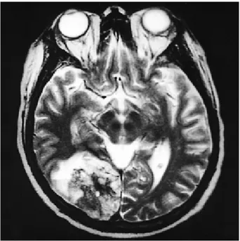 Fig. 3. Magnetic resonance scan of the brain. This T2-weighted scan shows an extensive right occipital lobe abscess with much surrounding edema.