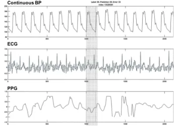 Fig. 8 Examples of Original Input Data with 22mmHg SBP Error and 33mmHg DBP Error