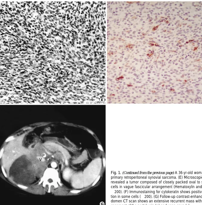 Fig. 1. (Continued from the previous page) A 36-yr-old woman with primary retroperitoneal synovial sarcoma