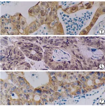 Table 3. MMP Immunoreactivity of tumor cells in gastric adeno- adeno-carcinomas MMP-2 - + MMP-3- + MMP-9- +