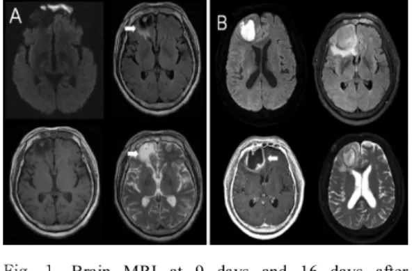 Fig.  1. Brain  MRI  at  9  days  and  16  days  after  headache  (A)  FLAIR  and  T2-weighted  images  showed  high  signal  intensity(Arrow)  in  the  right  frontal  cortex  at  9  days  after  headache