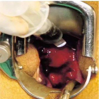 Fig. 4. Detection of sentinel lymph node using an isosulfan blue dye and hand-held gamma probe (A: hand-held gamma probe.