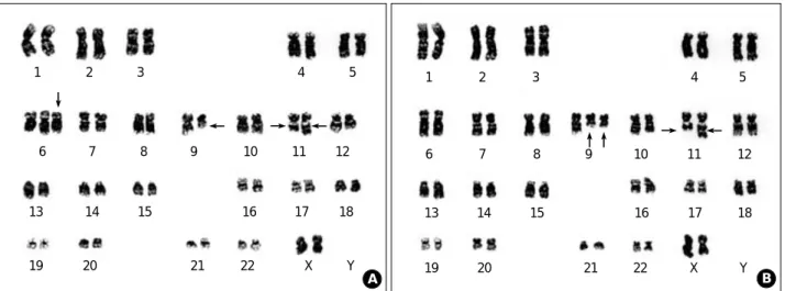 Fig. 4. Cytogenetic analysis of bone marrow. (A) Complex chromosomal abnormalities including +6, del(9)(q12q32), and t(11;11)(q23;q25) at the diagnosis of t-MDS