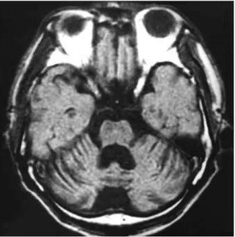 Fig. 2. The axial view of T1-weighted brain MRI shows a marked atrophy of the cerebellar hemispheres and 4th ventricular  dilata-tion.