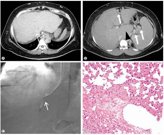 Fig. 3. Representative radiologic and pathologic images of the study patient. (A, B) Contrast-enhanced trans-  verse computed tomography obtained during the delayed phase showed poor opacification of the hepatic vein (black arrow), enlarged caudate lobe (b